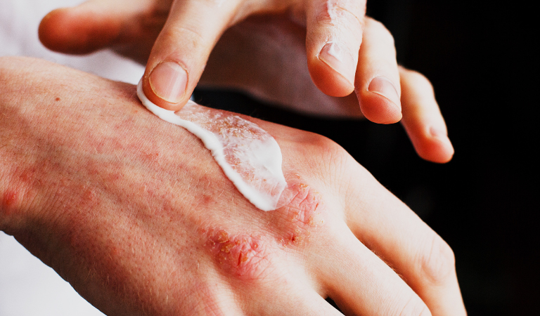 The Most Effective Home Remedies and Prevention Tips for Eczema