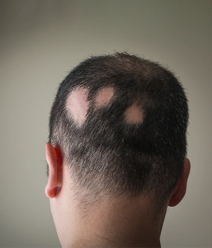 Alopecia Areata Causes