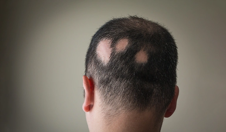 Alopecia Areata Causes
