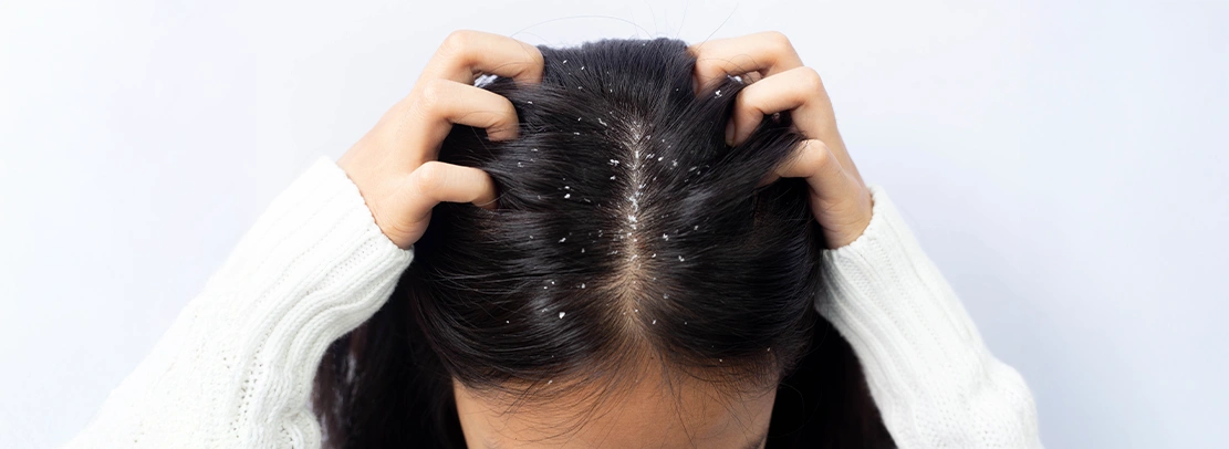 Dandruff vs. Dry Scalp – The Difference and Causes