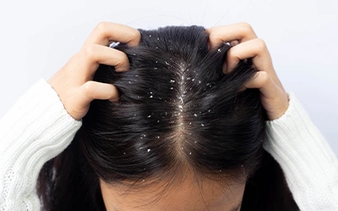 Dandruff vs. Dry Scalp – The Difference and Causes