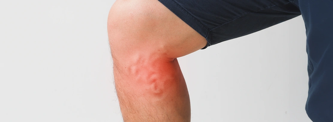 Cure for Varicose Veins