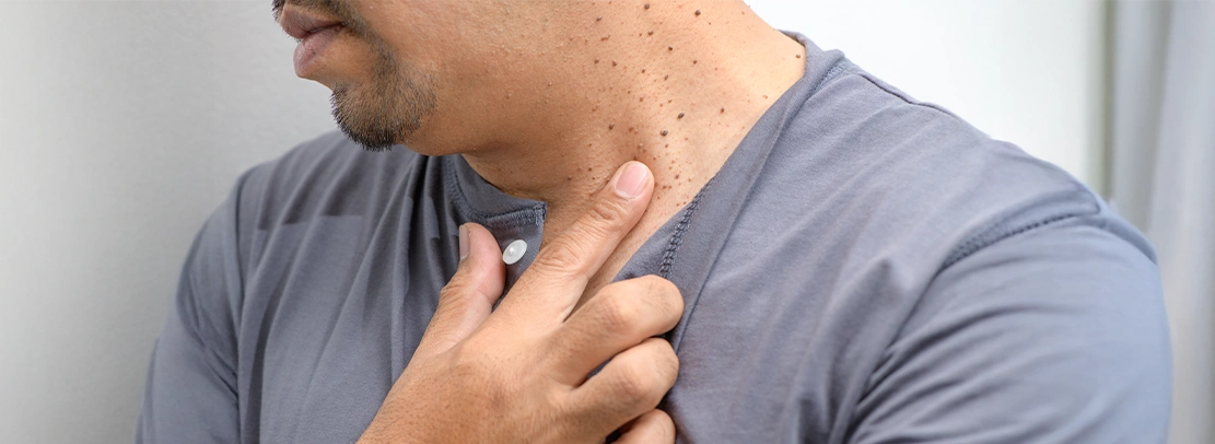 Warts & Skin Growths