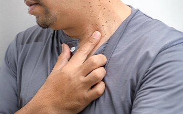 Warts & Skin Growths