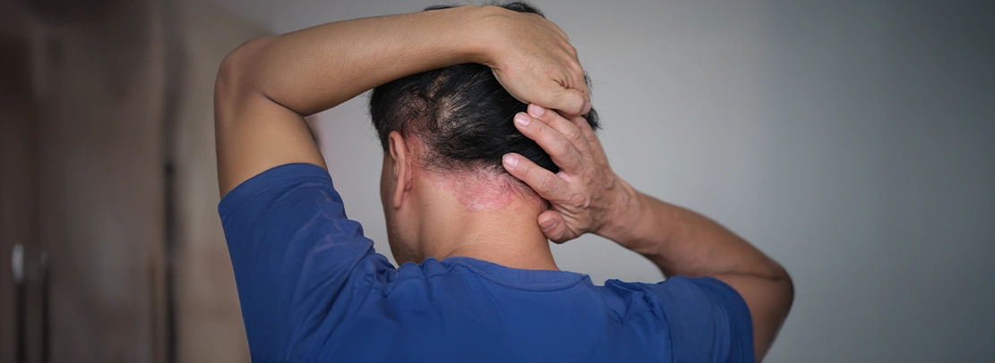 Scalp psoriasis