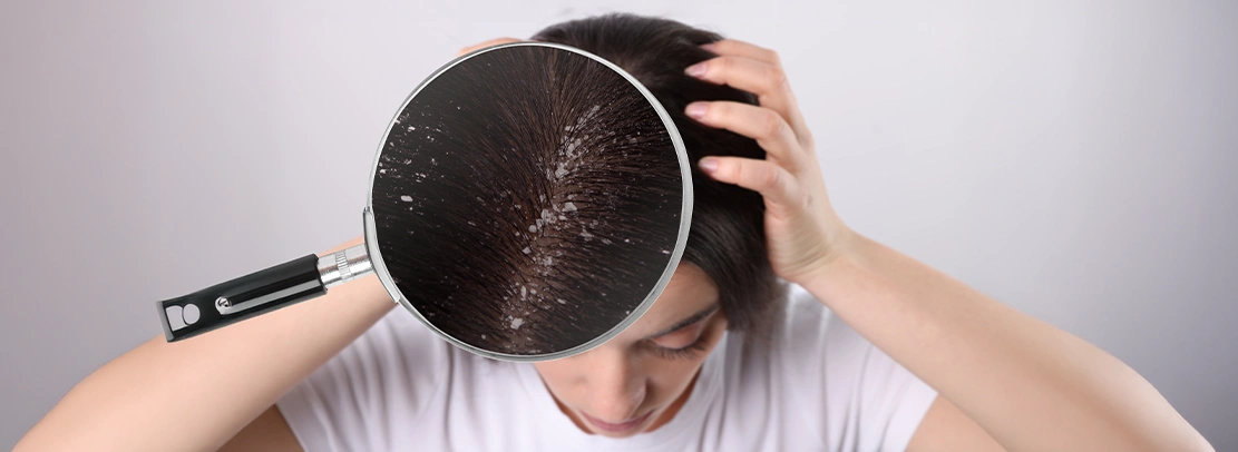 Dandruff