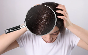 Dandruff