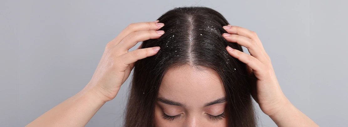 Dandruff Not Going Away