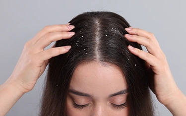 Dandruff Not Going Away