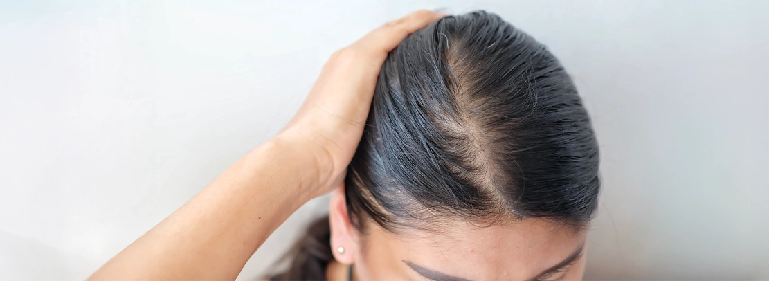 Hair Thinning