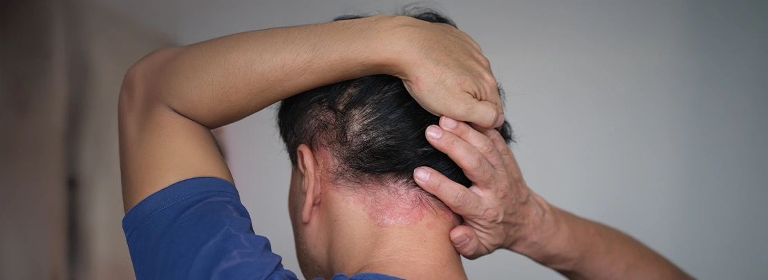 Scalp Psoriasis
