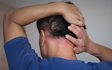 Scalp Psoriasis