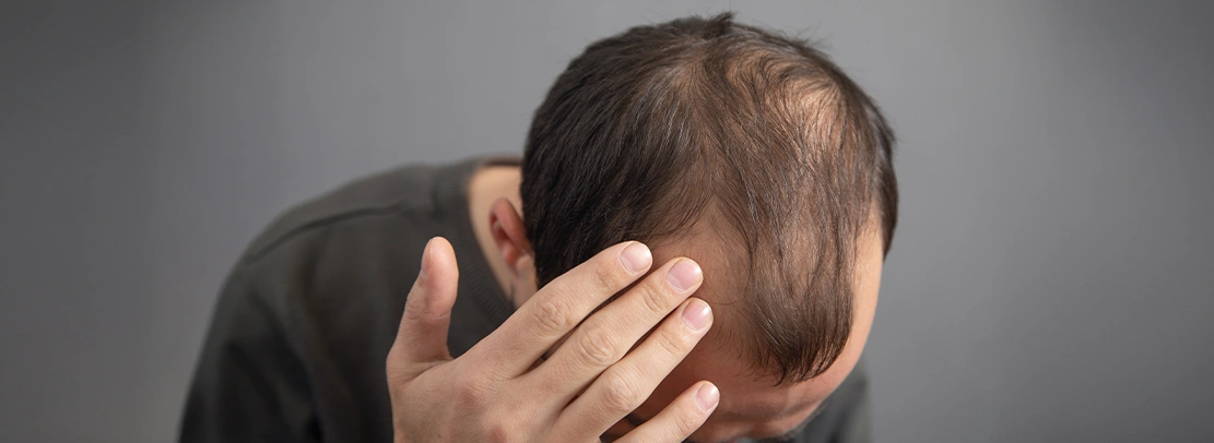 Steroid Injections for Alopecia