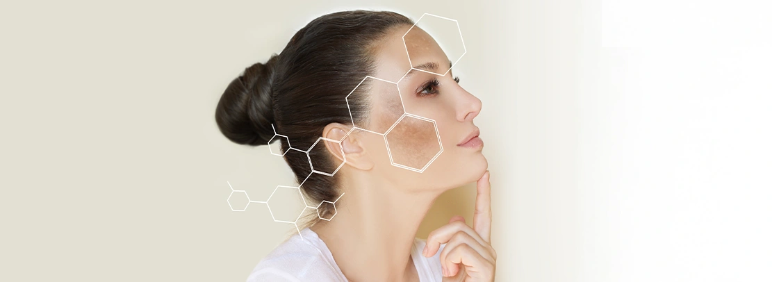 Pigmentation on the Face