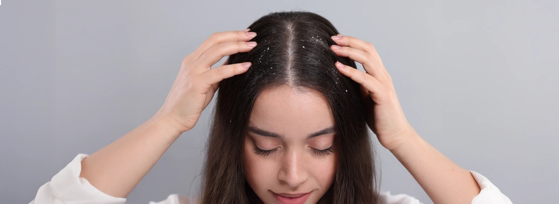 Surprising Reasons for Dandruff