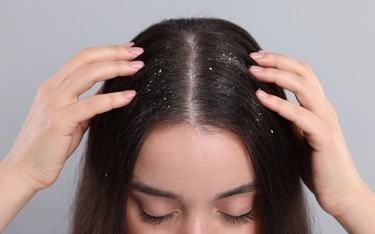 Surprising Reasons for Dandruff