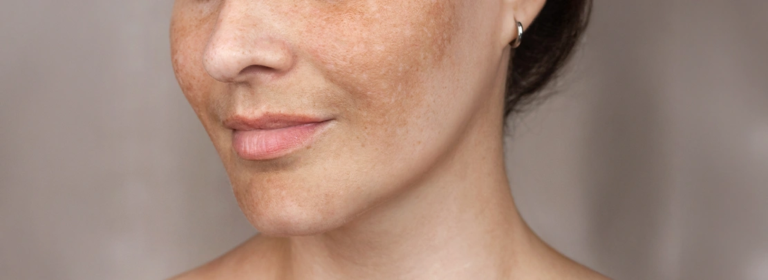 Melasma