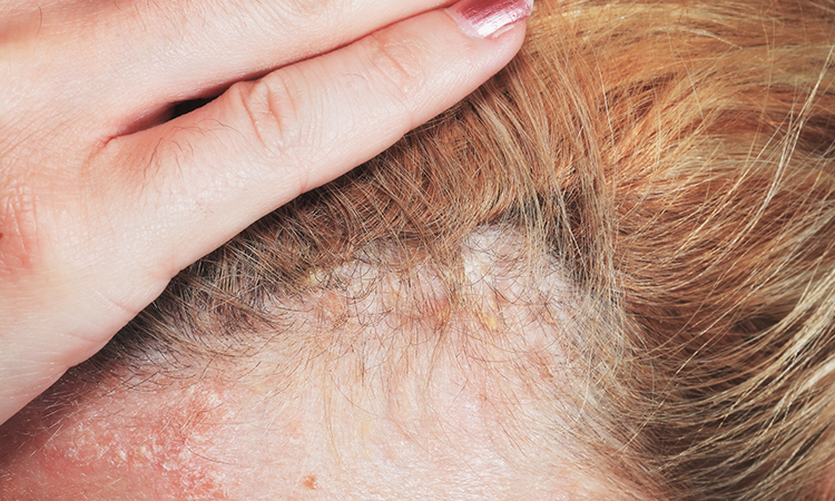 Psoriasis