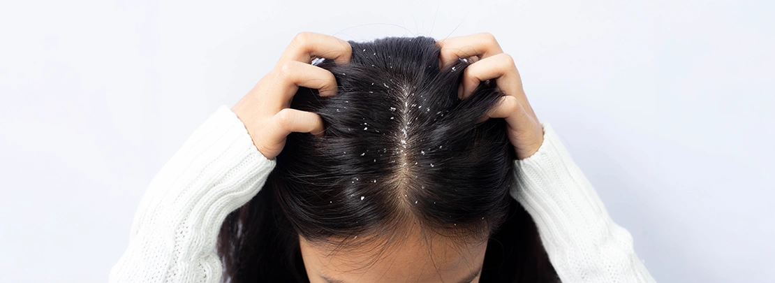 Dandruff