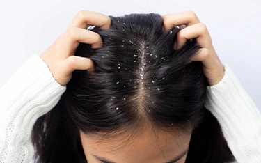 Dandruff