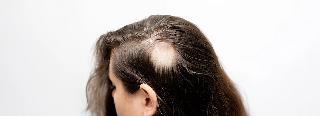 Alopecia Areata