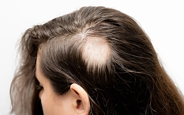 Alopecia Areata