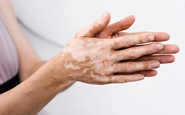 Vitiligo