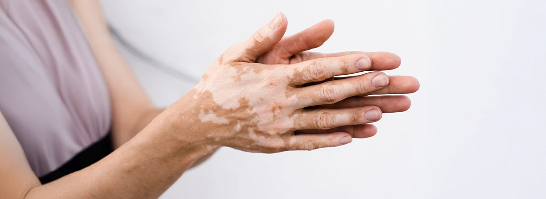 Vitiligo