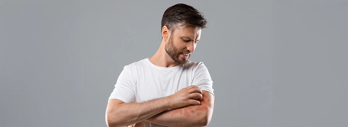 Psoriasis skin