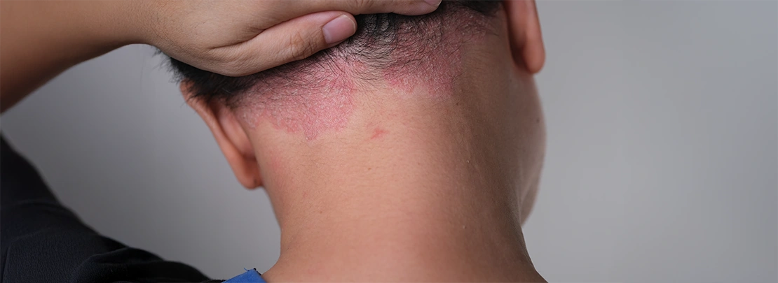 Scalp Psoriasis