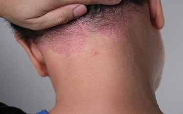 Scalp Psoriasis