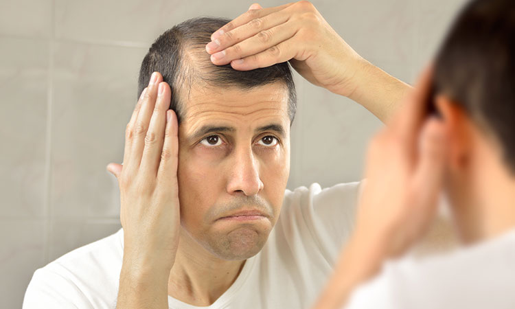 3 THINGS YOU SHOULD KNOW ABOUT MALE PATTERN BALDNESS