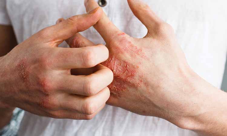 CAN ALLERGIES WORSEN ECZEMA