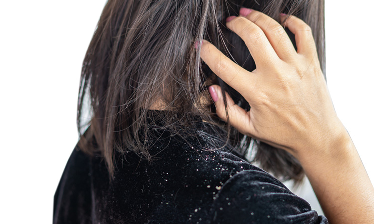 Does dandruff really need medical treatment