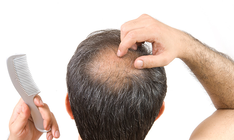 Which vitamin deficiencies can lead to hair fall
