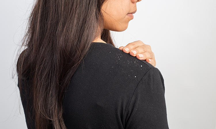 Dandruff vs. Dry Scalp – The Difference and Causes