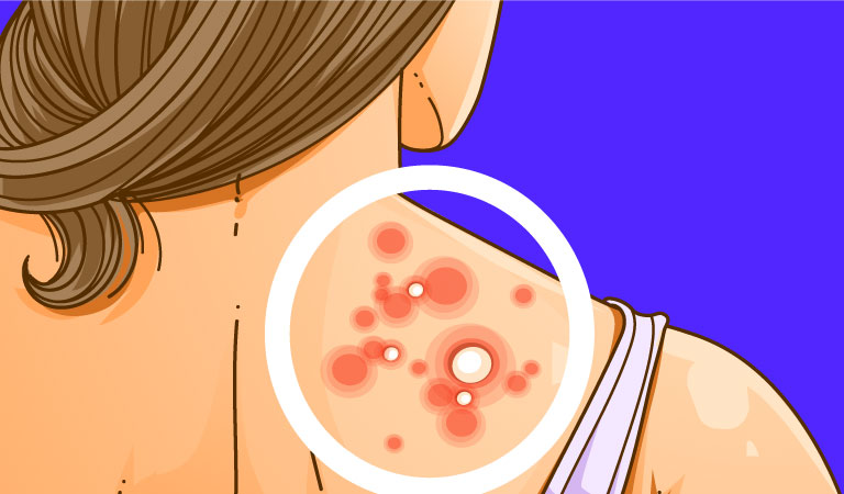 Back Acne Treatment: How to Get Rid of Back Acne?