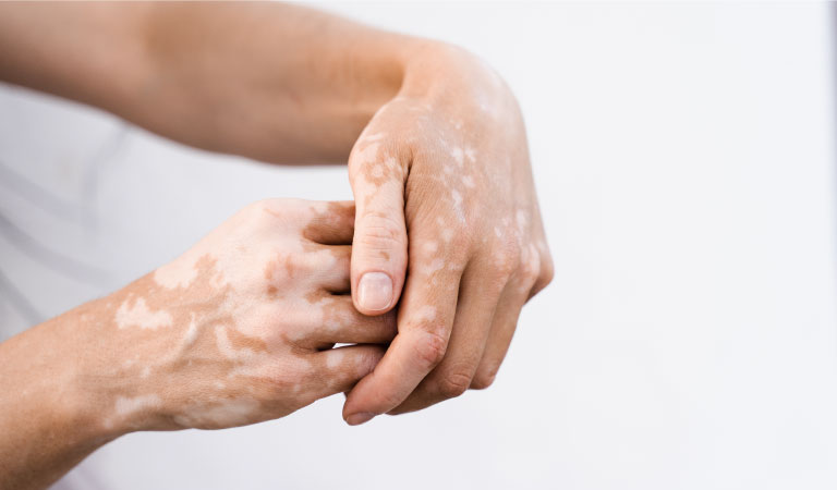 Vitiligo Cure - Can Medical Treatment Cure Vitiligo In 30 Days Find Out
