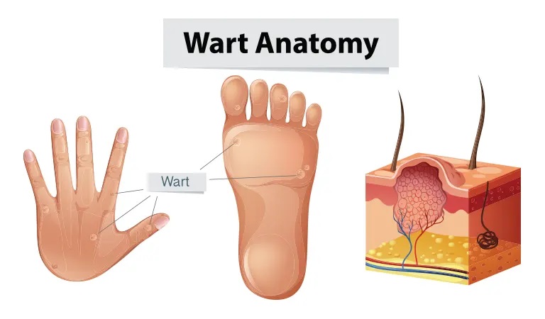 10 Easy Wart Removal Home Remedies
