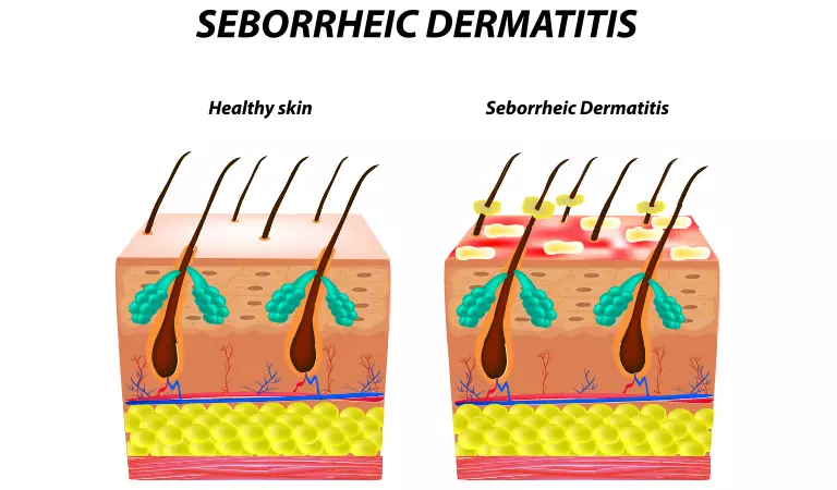 Seborrheic Dermatitis