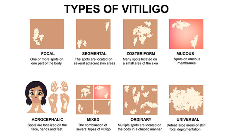 Vitiligo