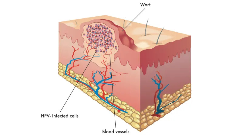 4 Types of Warts and Their Treatment at Dr Batra's®