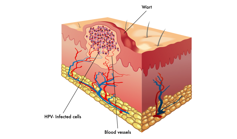 The Most Frequently Asked Questions on Wart Removal