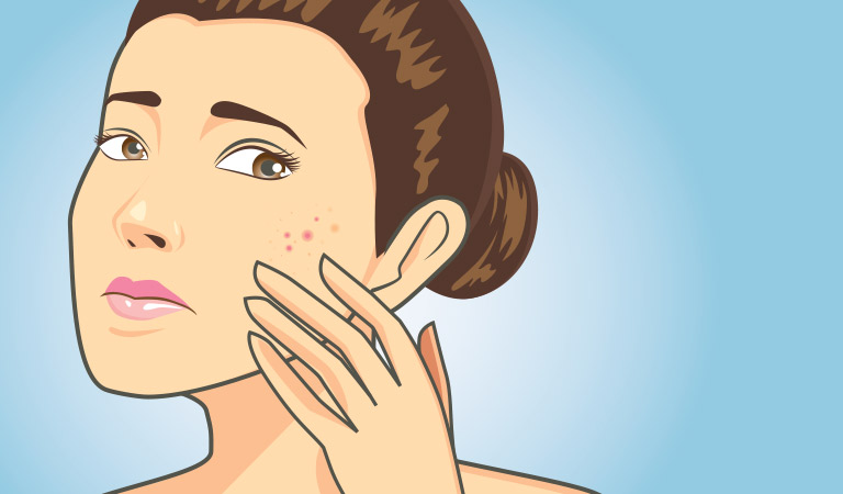 5 Types of Acne Scars: Everything You Need To Know