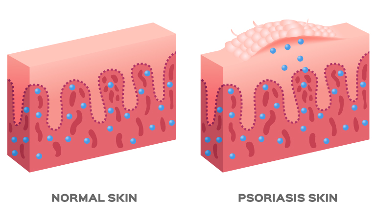 What is Psoriasis and Treatment for Psoriasis & Psoriatic Arthritis?