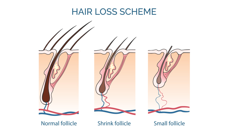 Hair Loss Scheme