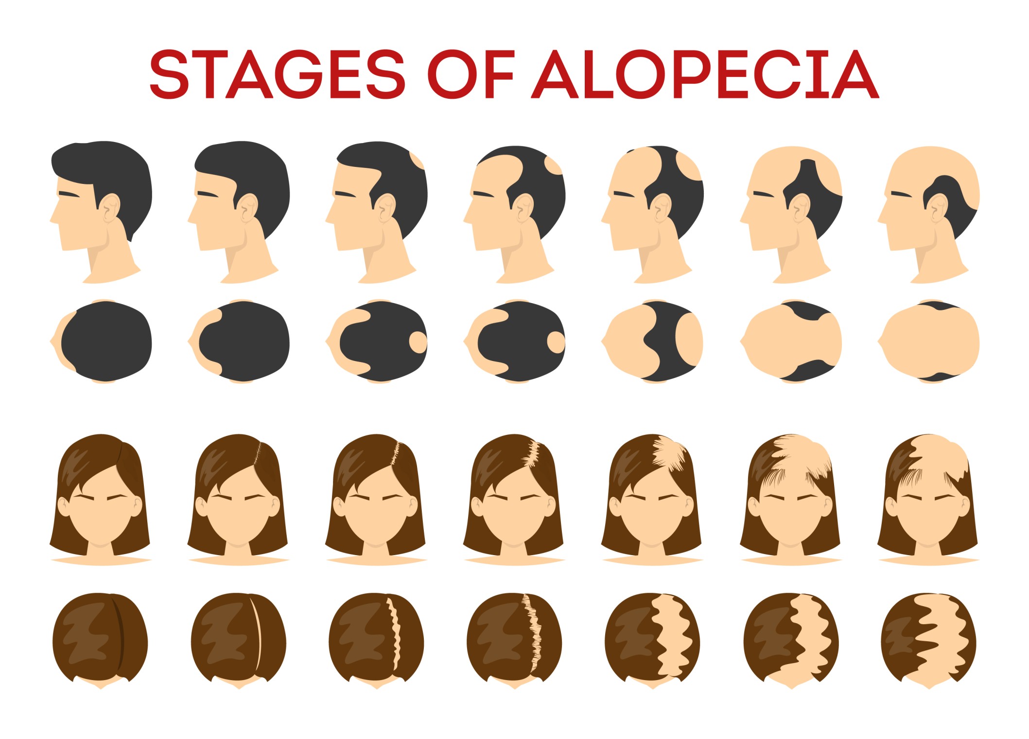 Alopecia-stages-set.-Hair-loss,-balding-process.-Female-and-male-alopecia.