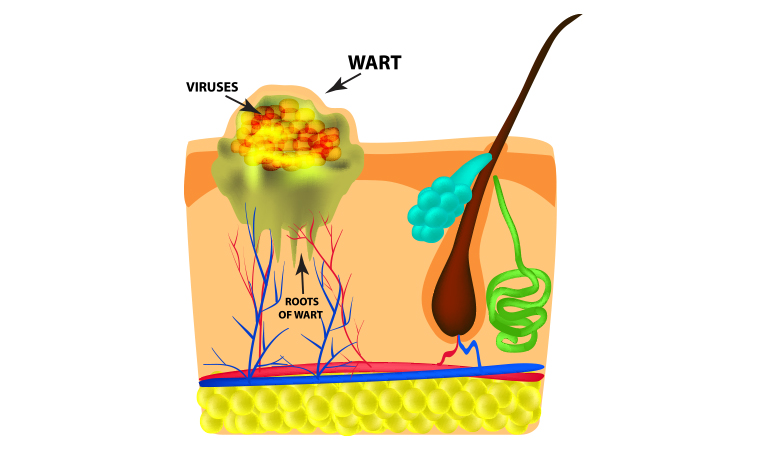 types_warts