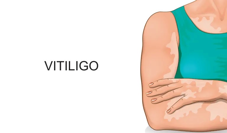 Do's and don'ts for vitiligo skin condition