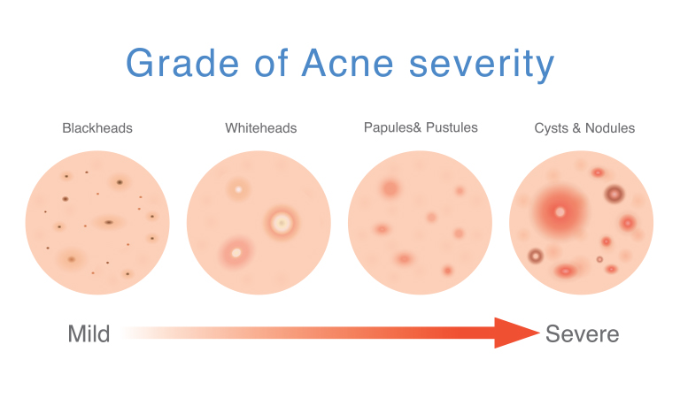 Hormonal_Acne